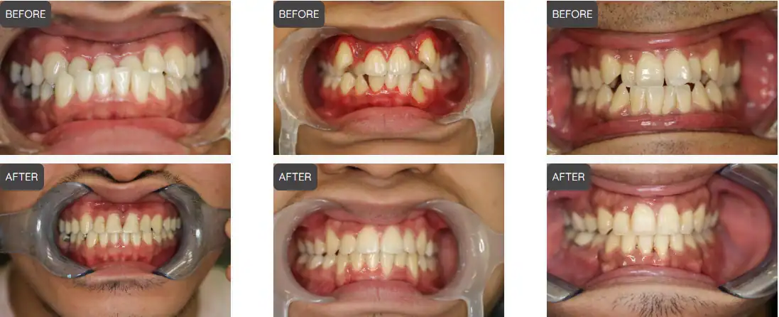 before and after braces and invisalign anaheim hills