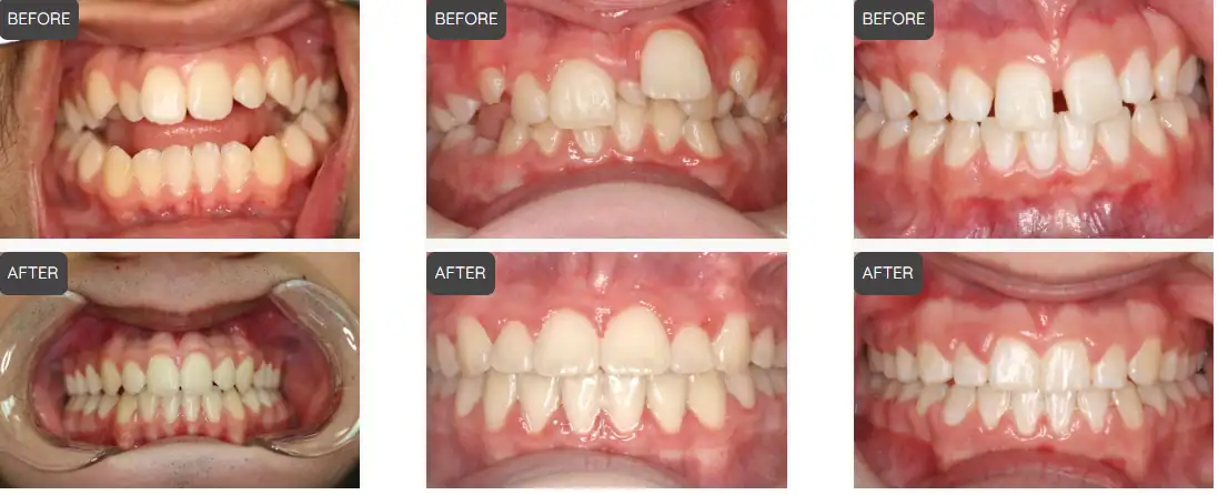 before and after braces anaheim hills