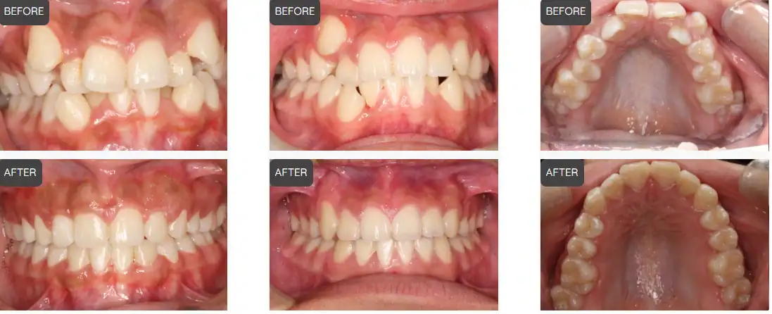 before and after invisalign anaheim hills