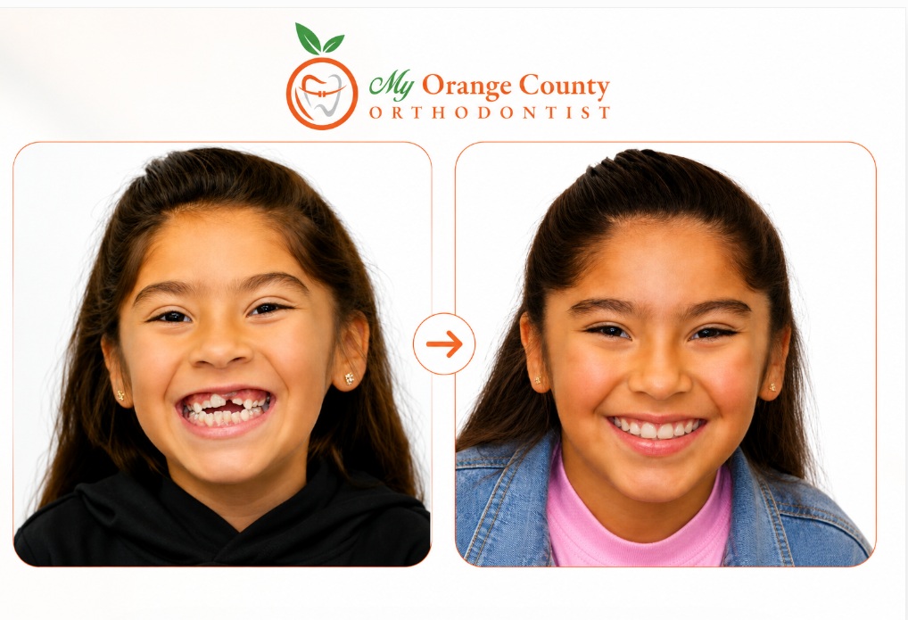 Before and after phase I orthodontic treatment for tongue thrust open bite and crossbite at My Orange County Orthodontist